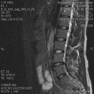 Дорзальная левосторонняя медіа-парафорамінальная грижа диска L4-L5