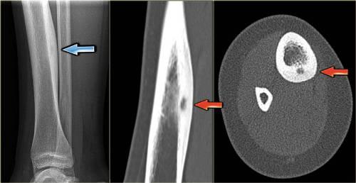 osteoid-osteoma